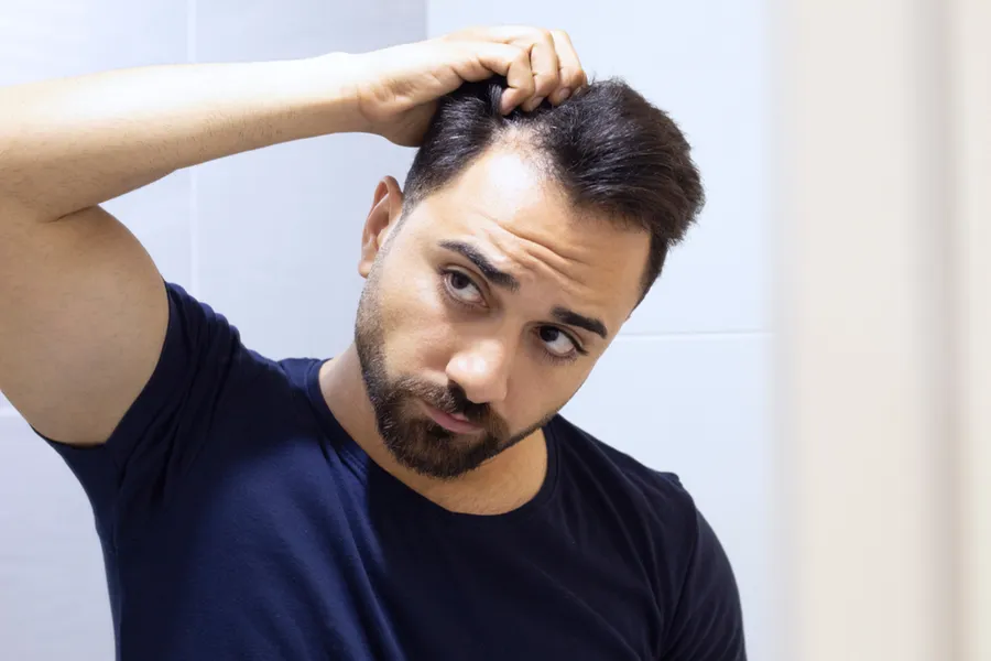 PRP-for-Hair-Loss-Doctor A man in a navy t-shirt looks in the mirror worrying about and touching his receding hairline, considering PRP for hair loss and restoration treatment from Marina Fay, PA-C in Aventura-North Miami.