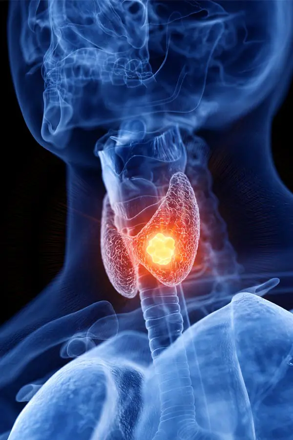 Thyroid-Imbalance-Treatment A 3D illustration of an x-ray of a human neck, highlighting the thyroid. Get help with thyroid imbalance from Marina Fay, PA-C in Aventura-North Miami.